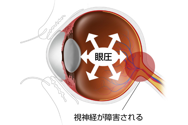 緑内障の状態